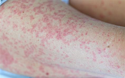 What Causes Red Spots On Skin And How To Treat Them Skinkraft