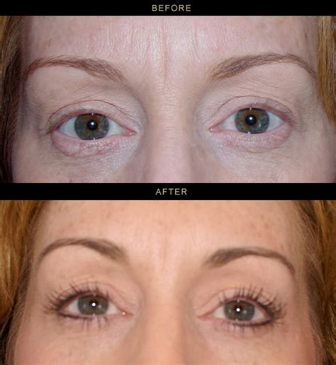 Permanent Eyeliner Photos Los Gatos Bay Area Timeless Skin Spa