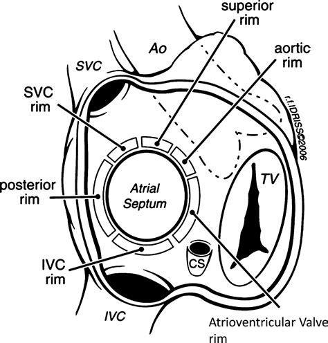 Patent Foramen Ovale Closure For Stroke Prevention And Other Disorders