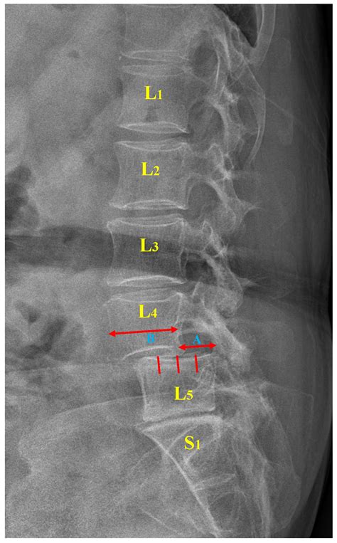 Jcm Free Full Text Detection Of Lumbar Spondylolisthesis From X Ray