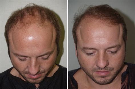 Hair Transplants For Men Photos Miami Fl Patient39867