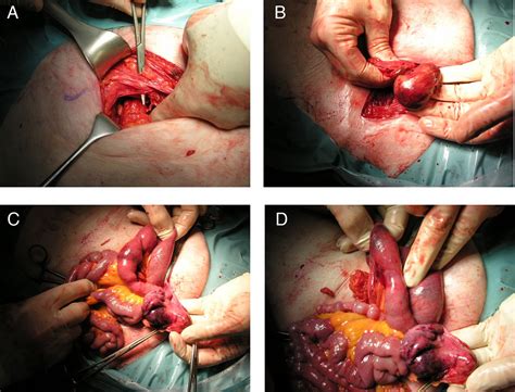 Coexisting ipsilateral right femoral hernia and incarcerated obturator
