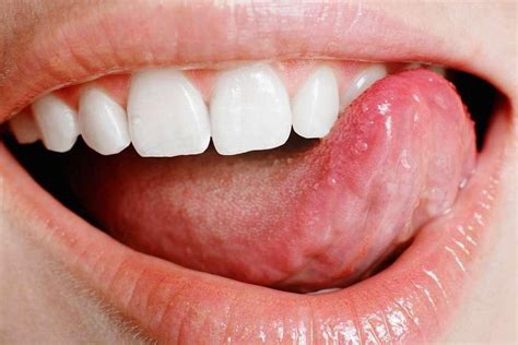 Canker Sores All You Need To Know About Symptoms Treatment Rozenberg
