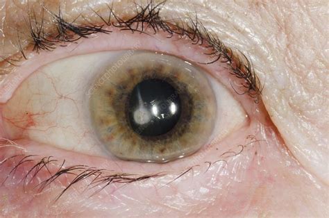 Cataract In The Eye Stock Image C0168226 Science Photo Library