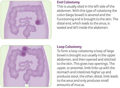 Colostomy How To Change A Colostomy Bag And Living With It