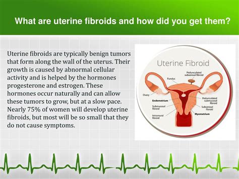 Fibroids Faqs Fibroid Frequently Asked Questions Faq Uterine Fibroids My Xxx Hot Girl