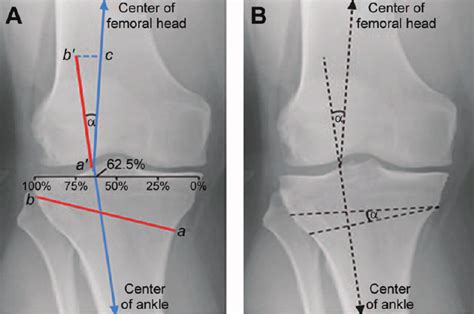 Angle Of Correction For A High Tibial Osteotomy A A To Determine