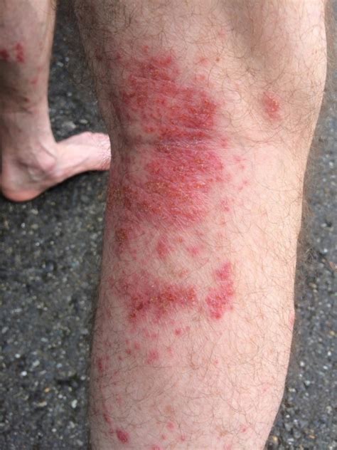 Hives Urticaria How Much Antihistamine Urticarial Rash Forums