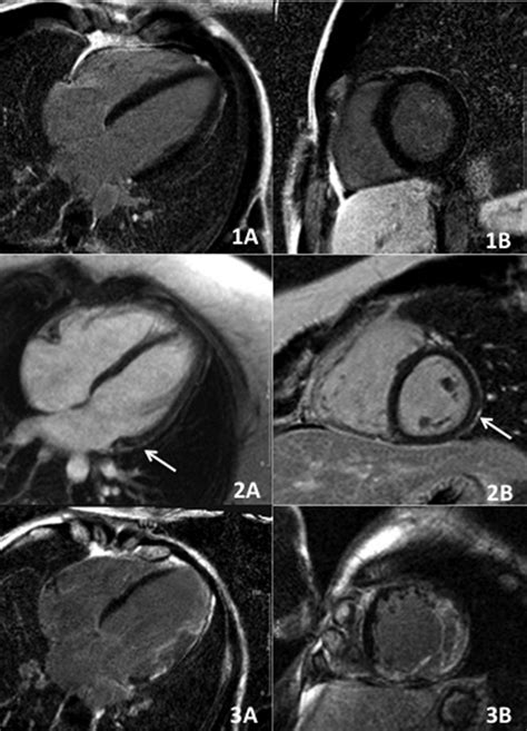 3 Clinical Utility Of Cardiac Mri In Young Middle Aged Patients With