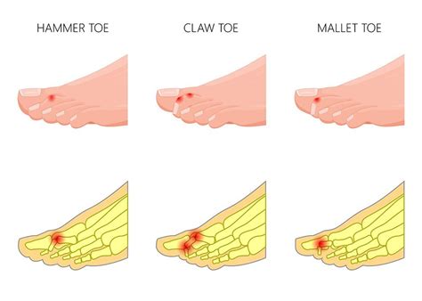 Hammertoe Corona Foot And Ankle Wound Care Center
