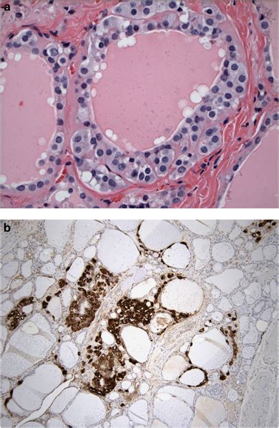 C Cell Hyperplasia In A Patient With Men Ii He A And Calcitonin B