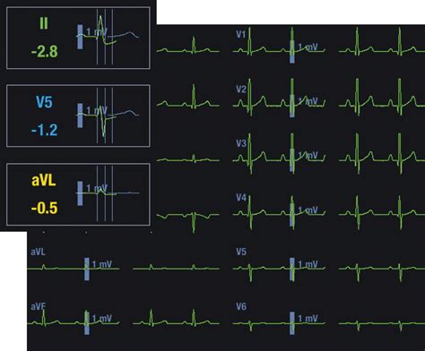 An Introduction To 12 Lead St Monitoring Clinical View