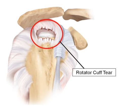 Rotator Cuff Tear And Impingement All You Need To Know