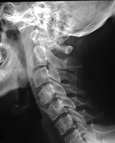 Dysphagia Related To Esophagus Compression By Anterior Cervical