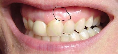 Hard White Bump On Gums