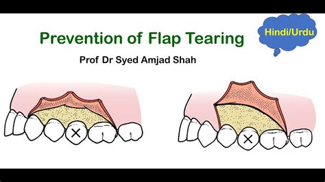 Prevention Of Flap Tearing Oral And Maxillofacial Surgery Syed Amjad Shah Youtube