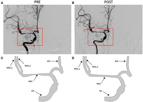 Frontiers Digital Subtraction Angiography Contrast Material Transport As A Direct Assessment