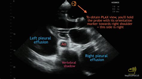 Identification Of Various Effusions On Standard Echocardiographic Views