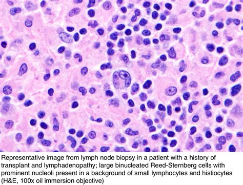 Pathology Outlines Classic Hodgkin Lymphoma Ptld