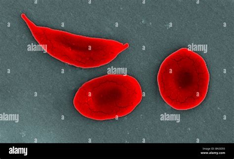 Sem De Un Glóbulo Rojo De Células Falciformes Fotografía De Stock Alamy