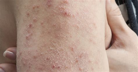 Causes Of Skin Rashes