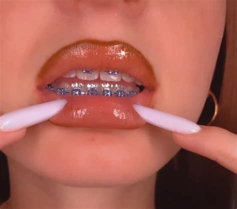 Tooth Gem Kit For Braces Etsy