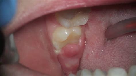 Pericoronitis Algodones Dentists Guide