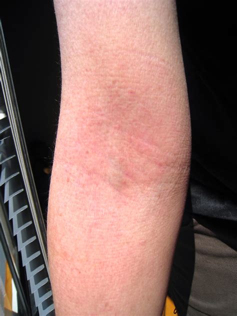 Topical Steroid Withdrawal Journey Healing Eczema And Red