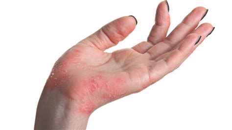 Signs You May Have Psoriasis And What To Do About It Allure