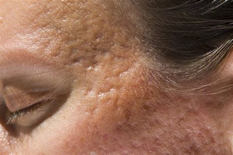 7 principais tipos de acne (e o que fazer) - Tua Saúde