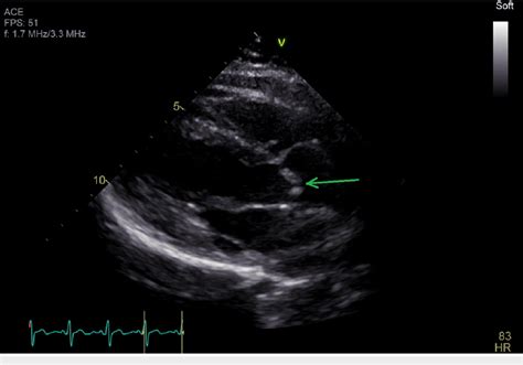 Figure 2 From A Rare Case Of Unicuspid Aortic Valve With Postoperative