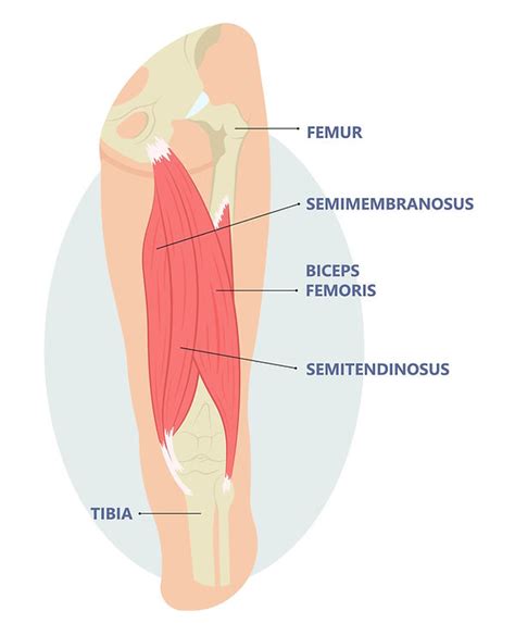 Proximal Hamstrings Tendonitis Musculoskeletal Ultrasound