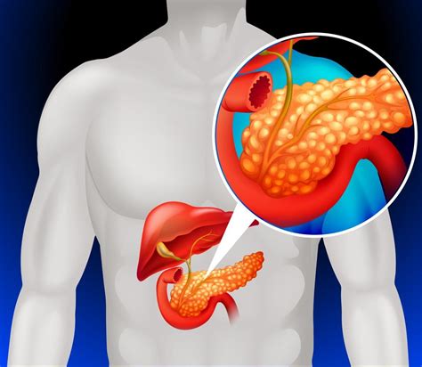 Understanding Pancreatic Cancer Causes And Treatments
