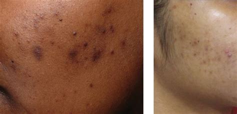 Red And Brown Acne Scars Dr Sadove Plastic Surgeon