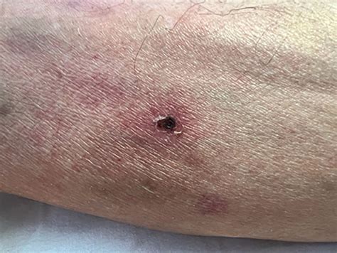 Scrub Typhus The Clinical Significance Of The Eschar Bmj Case Reports