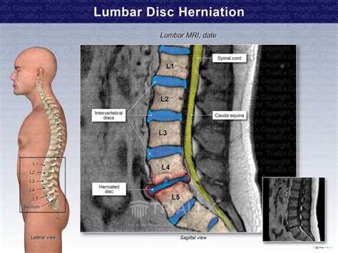 Lumbar Disc Herniation Trial Exhibits Inc