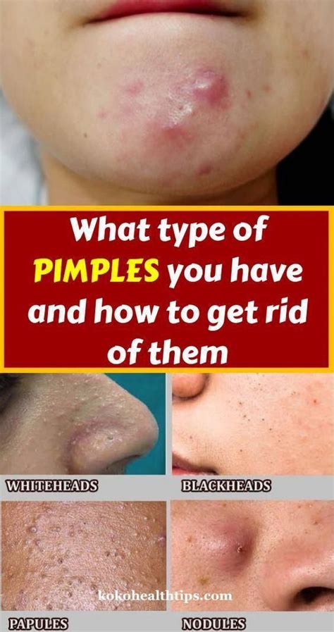 Do You Know What Type Of Pimples You Have And How To Get Rid Of Them