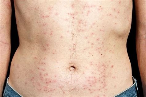 9 Common Bacterial Skin Infections