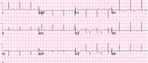 Dr Smiths Ecg Blog Septal Stemi With Lateral St Depression Then Has