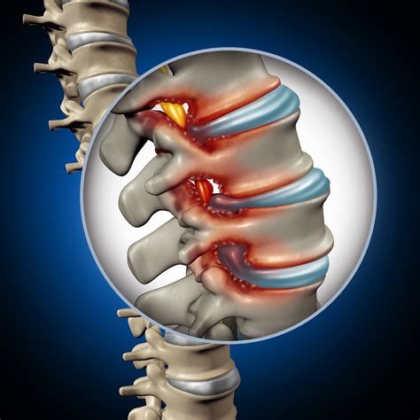 Progression And Complications Spinal Stenosis PainScale
