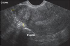 Mioma uterino o que é causas diagnóstico e tratamento Sanarmed