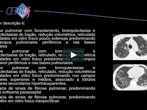 Preparatório De Radiologia 2017 Modulo Neuro Cabeça E Pescoço Pneumonias Intersticiais