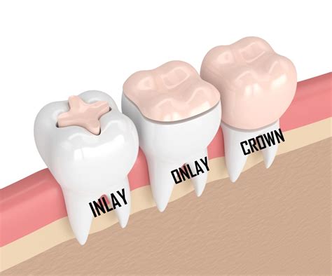 According to the american association of signs that a root canal treatment is necessary include severe pain while chewing, prolonged what will be the cost of porcelin crown in canada after root canal treatment is done. Do I need a crown after root canal treatment - DT Smile Care