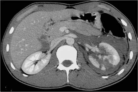 Abdominal Trauma Imaging Intechopen