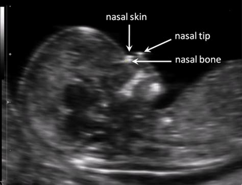 Nasal bone lengths are available for reference for assessing an indian population. Nasal Bone 20 Week Ultrasound Down Syndrome Markers - Cenfesse
