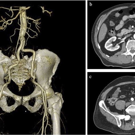 Two Year Follow Up Computed Tomography Ct Scan Of The Abdomen A