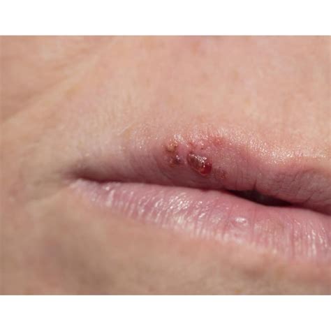Early Stage Herpes On Lip