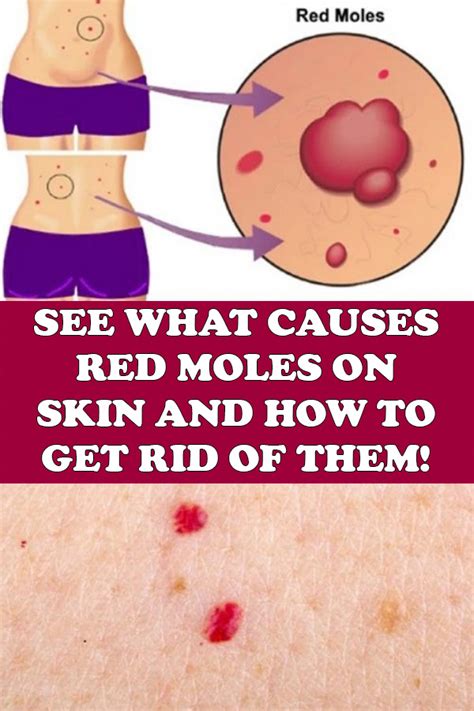 Finding A Red Mole On Your Body Can Be A Cause For Alarm But Mostly It