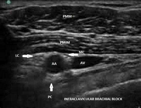 Infraclavicular Region Sonoanatomy Showing Cords Of Brachial Plexus As My XXX Hot Girl