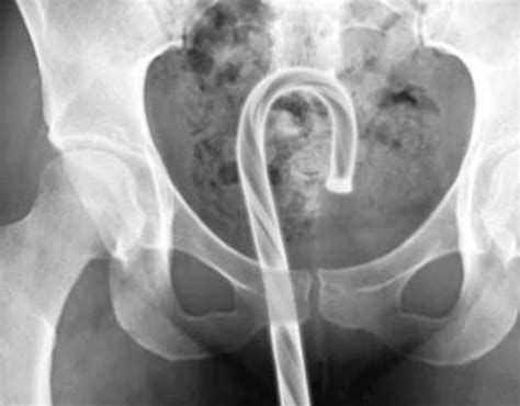 X Ray Of Things In Butt Great Porn Site Without Registration